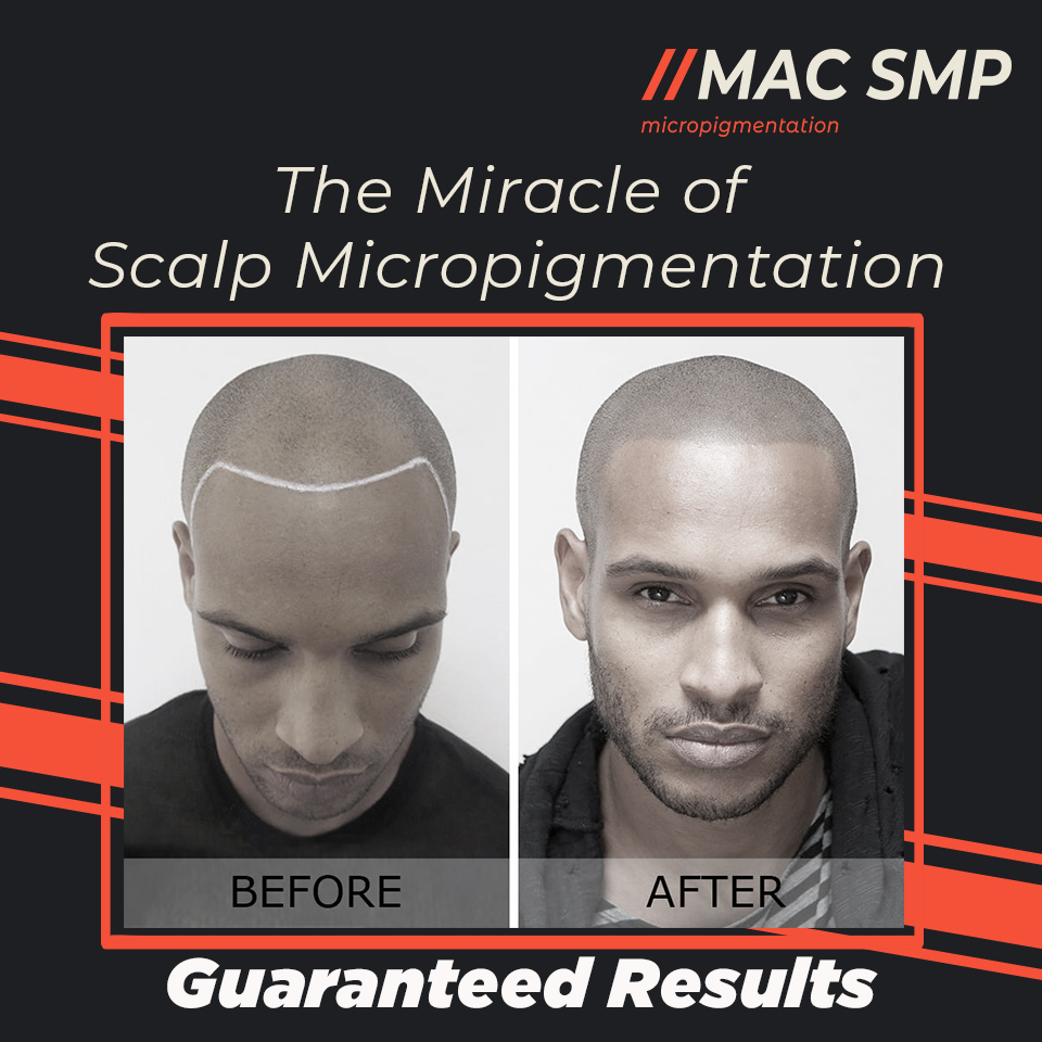 scalp micropigmentation new york