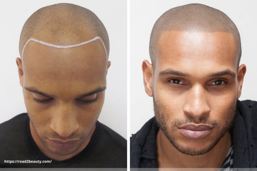 scalp micropigmentation benefits