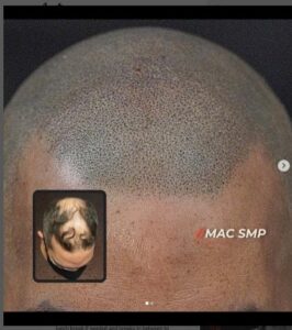 Why is Scalp Micropigmentation Better Than a Hair Transplant?