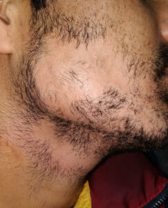 Alopecia beard