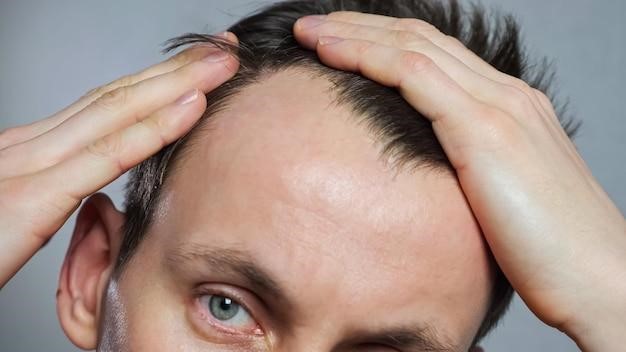Alopecia eyebrows