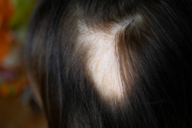 female pattern baldness
