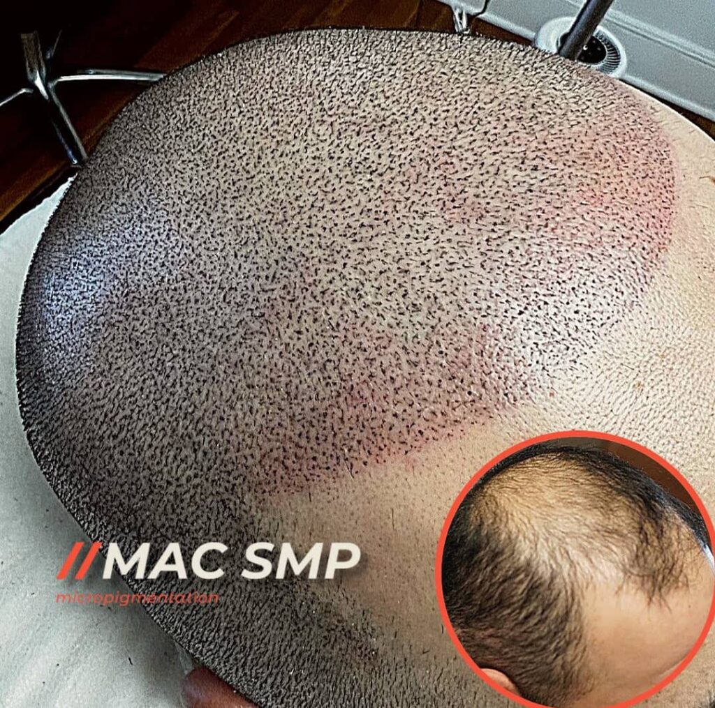 7 Stages of Hair Loss